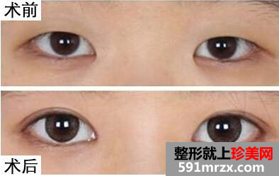  开眼角前后对比图，开眼角手术