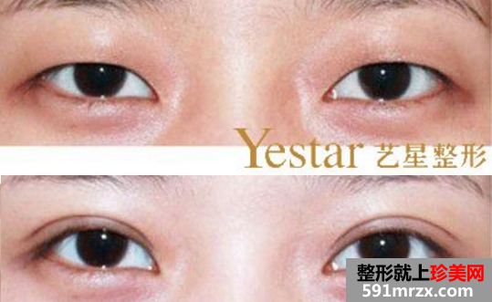双眼皮整形多少钱，整容前后对比图，整容价格表，整形医院价格表