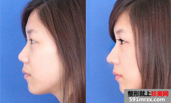 隆鼻整容前后对比图，上海美莱医疗美容医院整形价格表