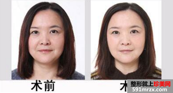 整形价格表，嫩肤除皱抗衰老整形前后对比图