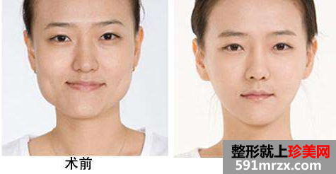 磨骨整形前后对比图,整形价格表，颌面整形费用