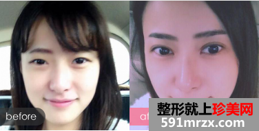 双眼皮多少钱？双眼皮整形手术前后对比图