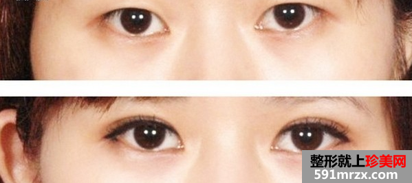双眼皮整形前后对比图,上海美之源整形外科医院整形价格表