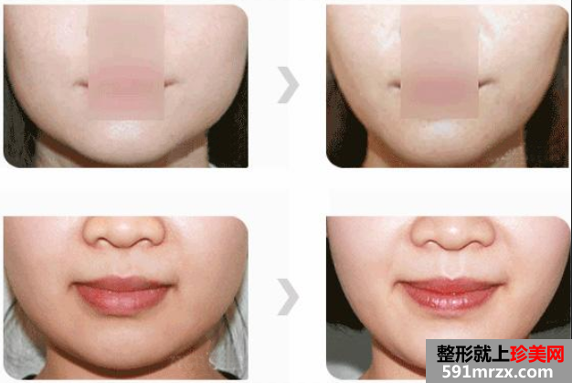 脸部整形前后图对比，整形医院价格表