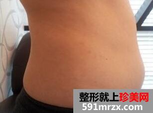 腹部吸脂前后对比和吸脂过程多图分享