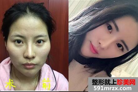 面部填充整形前后对比图，深圳阳光整形美容医院最新整形价格