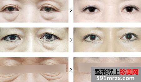 上海祛眼袋手术多少钱|最新价格表,祛眼袋手术前后对比图