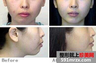 自体脂肪垫下巴前后对比图
