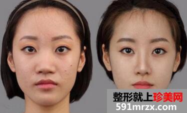 隆鼻需要多少钱，隆鼻前后对比图