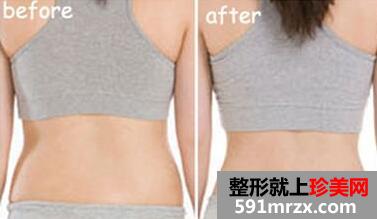 吸脂减肥多少钱？吸脂瘦腰腹前后对比图