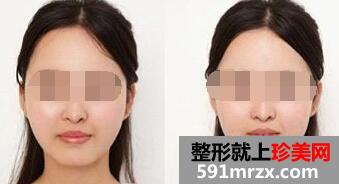 垫下巴有哪些方法?在广东广州自体脂肪垫下巴多少钱