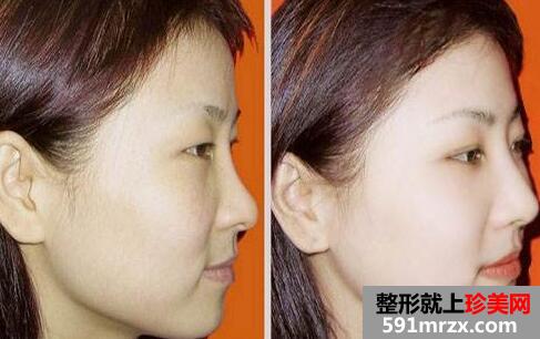 四川娇点医学美容医院美白嫩肤多少钱，美白嫩肤前后对比图