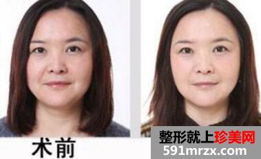 点击查看上海玫瑰医疗美容医院整形价格是多少?热玛吉紧致除皱多少钱?