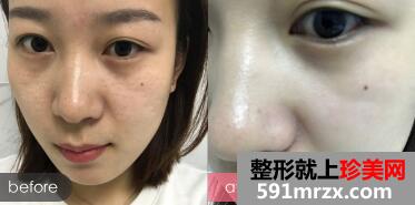 激光祛斑前后对比图
