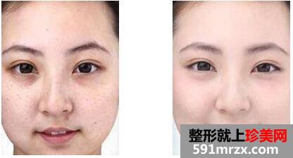激光去雀斑前后对比图