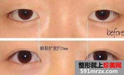割双眼皮和开内眼角前后对比图