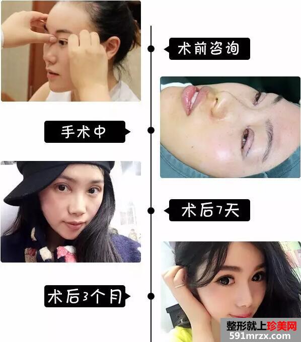 割双眼皮