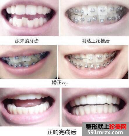 牙齿正畸前后图片