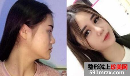玻尿酸隆鼻图片