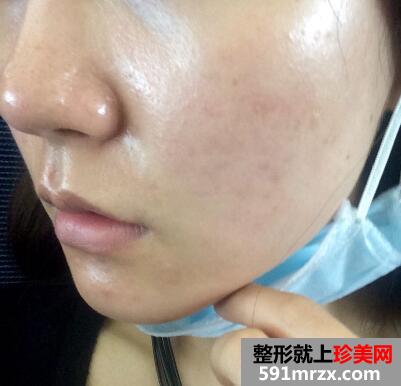黑脸娃娃治疗前照片