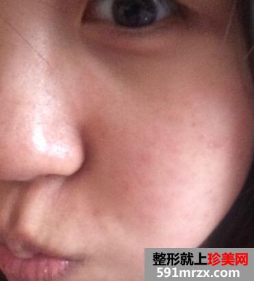 大S推荐的黑脸娃娃有效果吗？我的黑脸娃娃案例分享