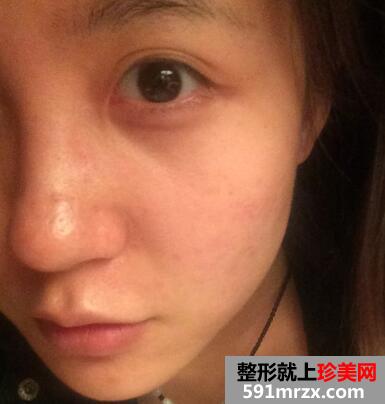 大S推荐的黑脸娃娃有效果吗？我的黑脸娃娃案例分享
