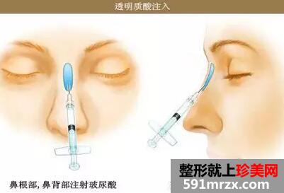 玻尿酸注射隆鼻原理图