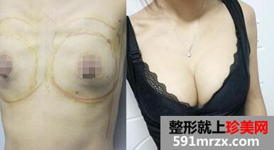 丰胸前后对比图，武汉美来莱整形医院最新价格表 武汉整形医院推荐