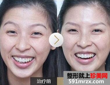 去抬头纹前后对比图，去抬头纹手术多少钱？