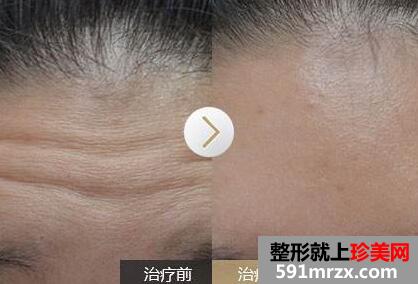 去抬头纹前后对比图，去抬头纹手术多少钱？