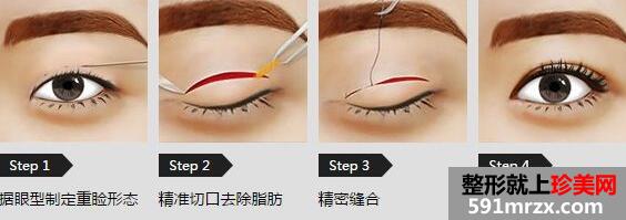 切开双眼皮原理图