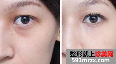 超声波去眼袋前后对比图，超声波去眼袋多少钱？