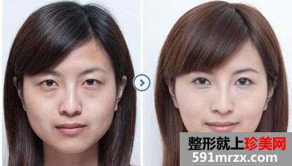 超声波去眼袋前后对比图，超声波去眼袋多少钱？