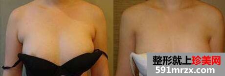 副乳切除前后对比效果图，副乳手术需要多少钱？