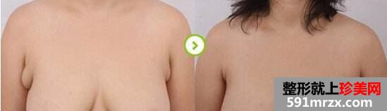 副乳切除前后对比效果图，副乳手术需要多少钱？