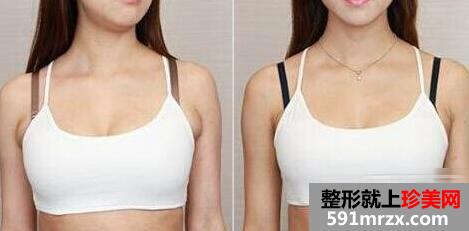 副乳切除前后对比图