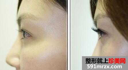 种睫毛前后对比图，种睫毛要多少钱？