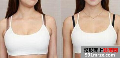 副乳切除效果对比图，腋下副乳手术价格
