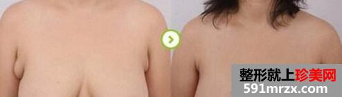 腋下副乳手术价格，副乳手术图片