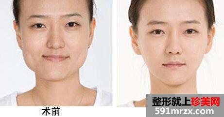 下颌角整形图片，价格介绍