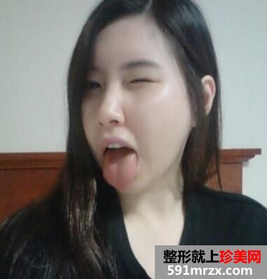 下颌角整形案例和对比照片