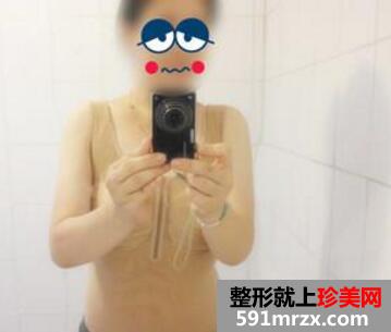 水动力吸脂瘦身减肥整形日记