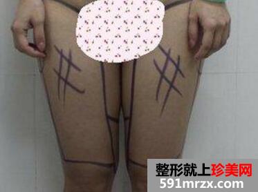 大腿吸脂减肥后恢复过程_真实案例分享