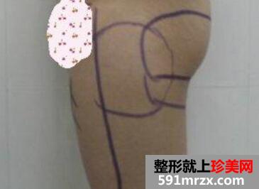 大腿吸脂减肥后恢复过程_真实案例分享