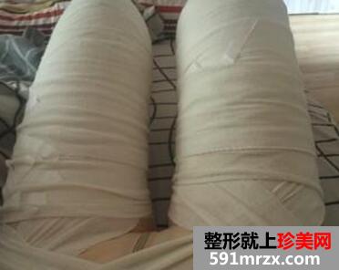 大腿吸脂减肥后恢复过程_真实案例分享