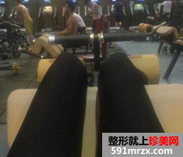 大腿吸脂减肥后恢复过程_真实案例分享