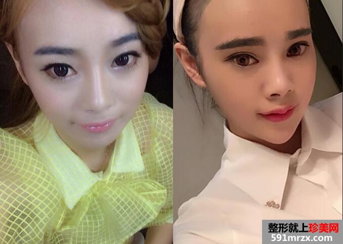 玻尿酸丰唇恢复过程和前后对比图
