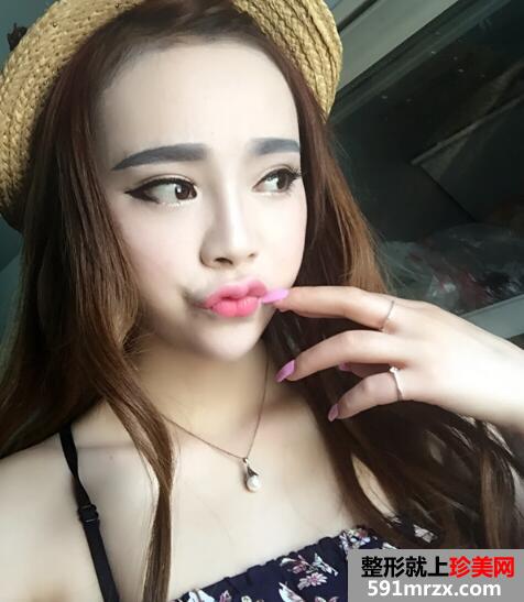玻尿酸丰唇恢复过程和前后对比图