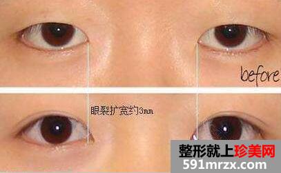 割双眼皮开眼角前后对比图，武汉美来莱整形医院最新价格表 武汉整形医院推荐