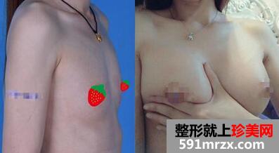 丰胸前后对比图，隆胸价格表
